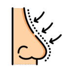 Rhinoplasty