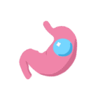 SPATZ Gastric Balloon